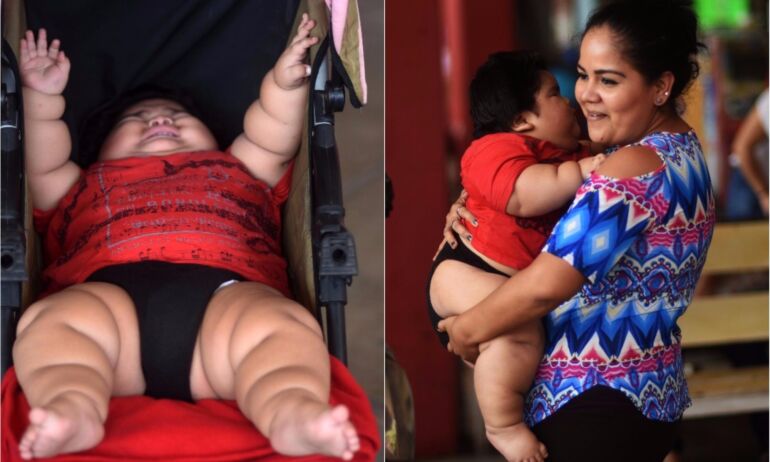 10 mėnesių kūdikis sveria 28 kilogramus: gydytojai baiminasi dėl jo gyvybės