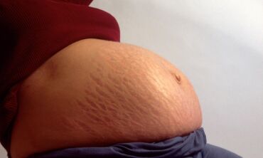 Moterys kviečiamos pamilti kūną darkančias strijas FOTO