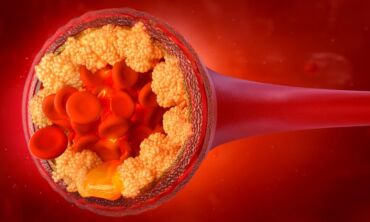 „Neskaudantis“ ir niekaip nejuntamas cholesterolis gali tapti ūminio skausmo krūtinėje priežastimi ir lemti miokardo infarktą