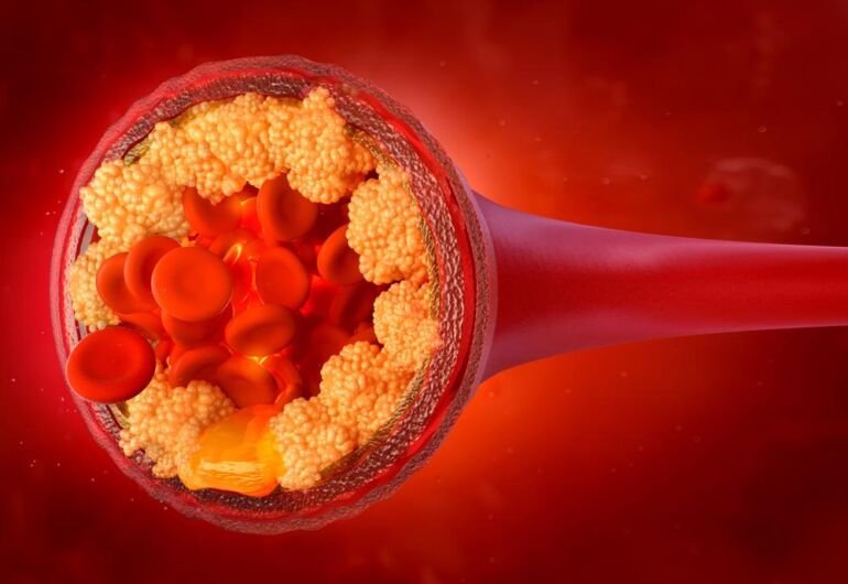 „Neskaudantis“ ir niekaip nejuntamas cholesterolis gali tapti ūminio skausmo krūtinėje priežastimi ir lemti miokardo infarktą