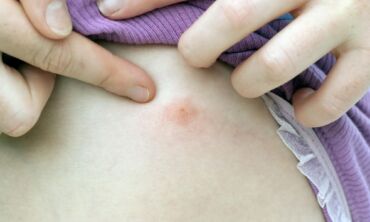 Veiksmingos natūralios priemonės nuo vabzdžių įkandimų