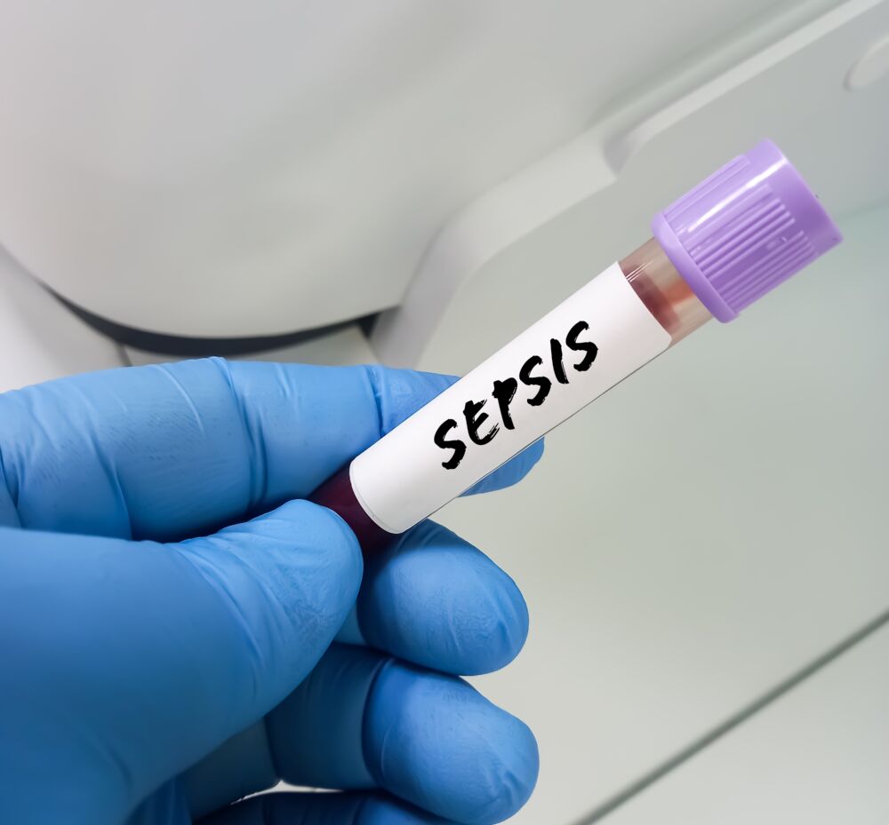 Sepsis: kodėl jo gydymas primena detektyvą?